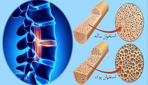  همایش پوکی استخوان و ورزش در رشت برگزار شد