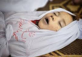 نوزادان فلسطینی با انبوه تاولها جان می دهند!!